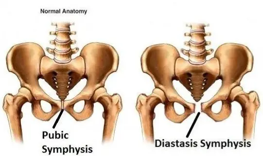 Pubis Diastasis - A Real Pain in the Crotch