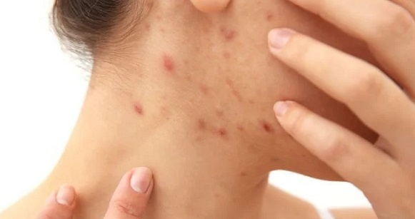 6 All-Natural Pregnancy Acne Remedies